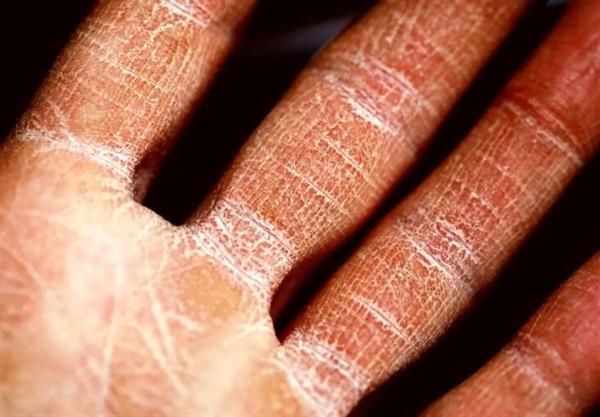   تغییرات اقلیمی، دشمن اگزما؛ آلودگی هوا و دماهای شدید بیماری پوستی را تشدید می‌کنند 