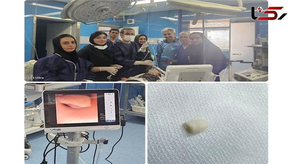  نجات شیرخوار سمنانی از خفگی با بادام زمینی 