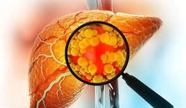  رابطه PCOS با ابتلا به کبد چرب! 
