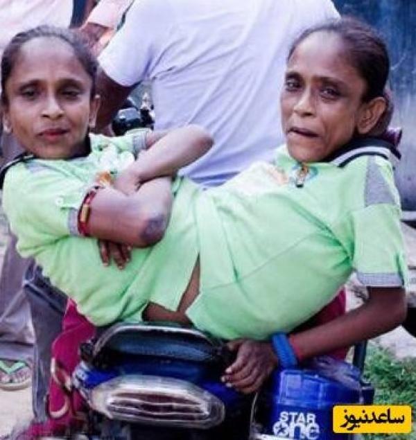 دو خواهر به هم چسبیده که با یک مرد ازدواج کردند + عکس شوهر