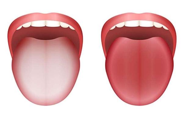 زبان سفید چه چیزی درباره سلامت می‌گوید؟