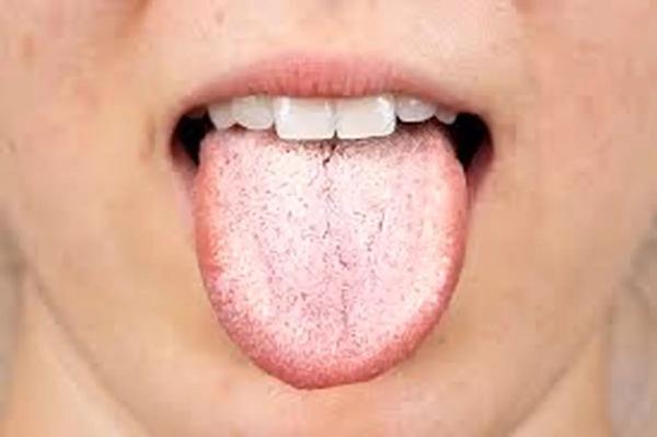   رنگ زبان سفید نشانه چیست؟ 