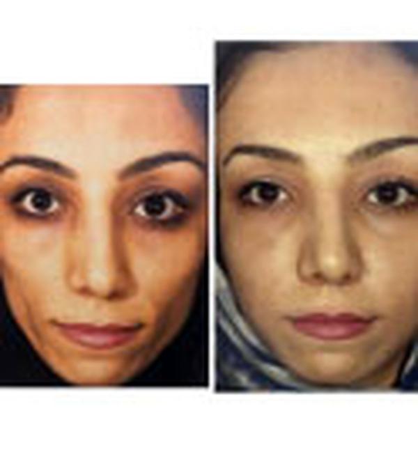 جوانسازی صورت به روش نوراریژن؛ روشی ترکیبی با ماندگاری بالا