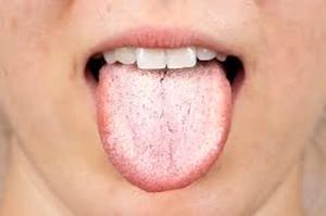 رنگ زبان سفید نشانه چیست؟