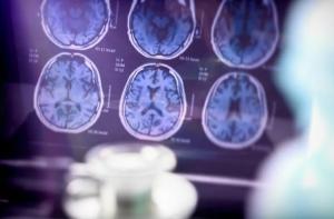 هوش مصنوعی با یک اسکن به تشخیص 9 نوع زوال عقل با دقت 88 درصدی کمک میکند